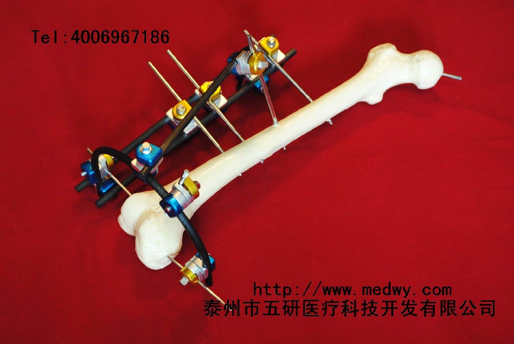 骨折、關(guān)節(jié)炎與四肢畸形患者福音