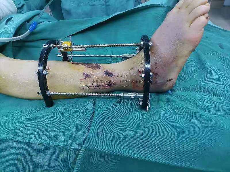 病例分享——踝關(guān)節(jié)粉碎性骨折（PILONG骨折）（糖尿病?局部皮膚條件差）