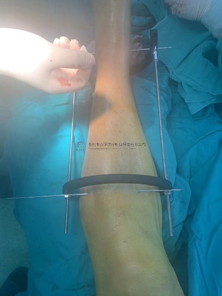 【望京醫(yī)院】不開(kāi)刀治骨折——CO接骨架典型病例分享